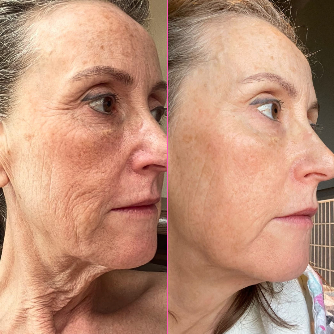A side-by-side before and after comparison of a woman's face (after using the Tria FRX) showing a visible reduction in skin wrinkles and hyperpigmentation on the right side.